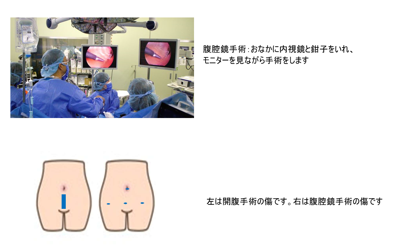 腹腔鏡手術_フォント変更後.png